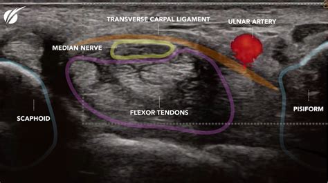 carpal compression test fa|carpal tunnel syndrome ultrasound.